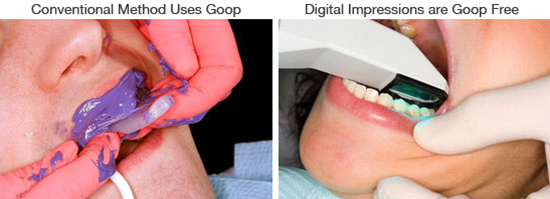 Conventional and Digital Impressions